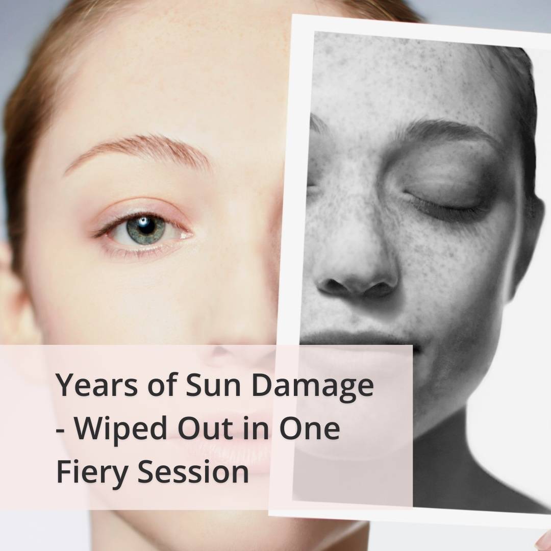 Here is How She Reversed 10 Years of Sun Damage VBeauty Medical Spa
